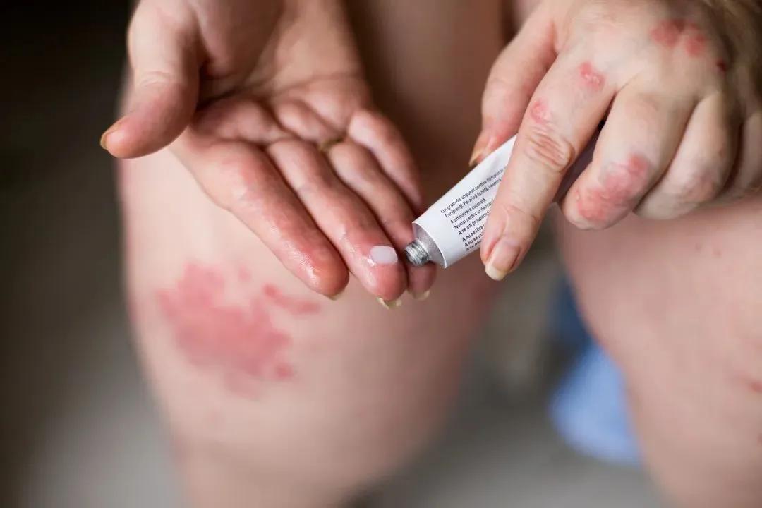 你买的药膏正规吗？无药物批号、违规添加激素，让病情加重的「皮肤神药」仍在畅销！