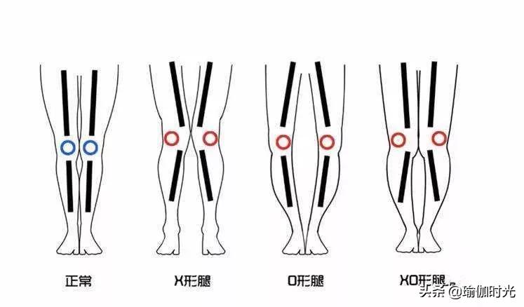O型腿不动手术真的能改善吗,o型腿为什么一只腿弯一只腿直