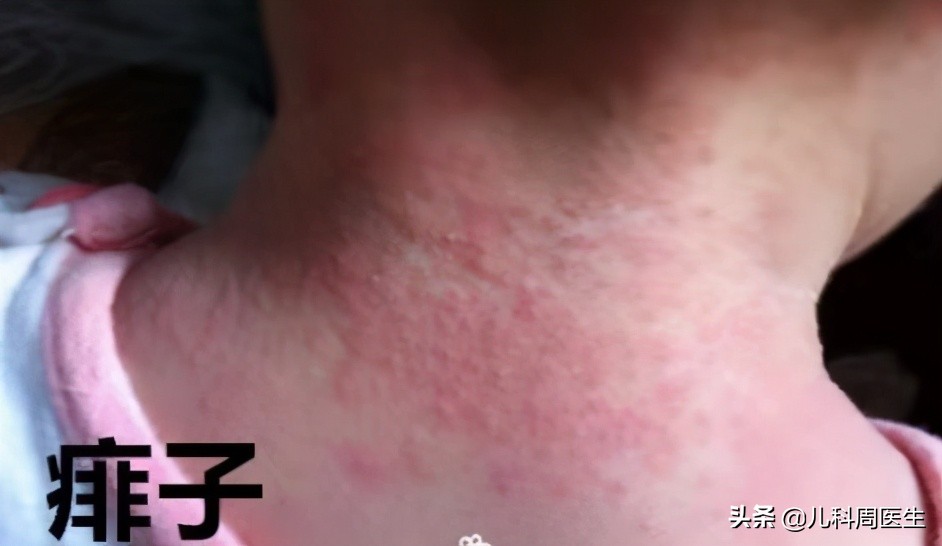 宝宝长痱子淹脖子怎么办,痱子和湿疹的预防和护理