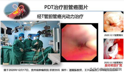 贵州省肿瘤医院肝胆外科已经在省内率先开展肿瘤光动力治疗