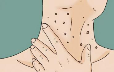 脖子上长的小肉粒可以揪下来吗,脖子腋下长小肉粒可以用手揪掉吗