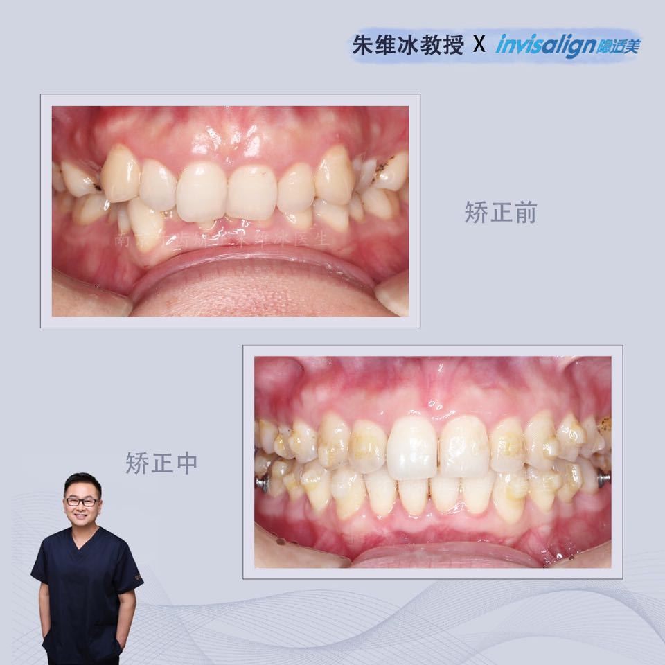 隐适美牙齿拥挤矫正真实案例,南京朱维冰