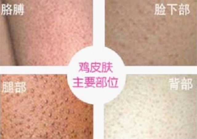 果酸精华改善鸡皮肤,医院果酸换肤鸡皮肤能用吗