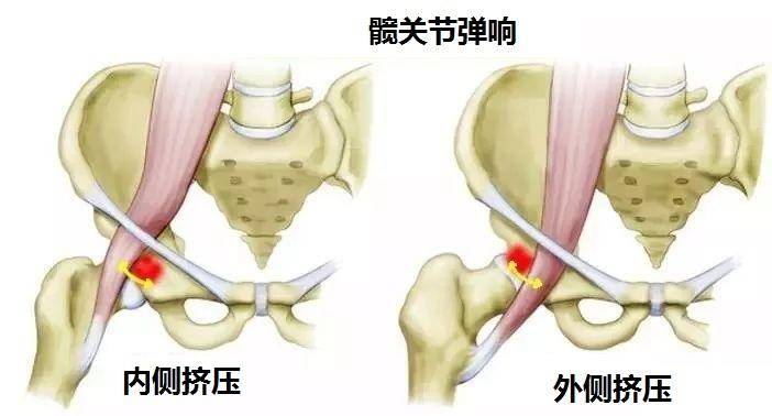 久坐腹股沟酸胀是怎么回事,久坐腹股沟疼痛的原因