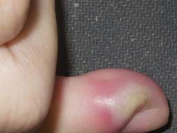 关节炎可以通过打抗生素治疗吗,关节炎治疗的注意事项