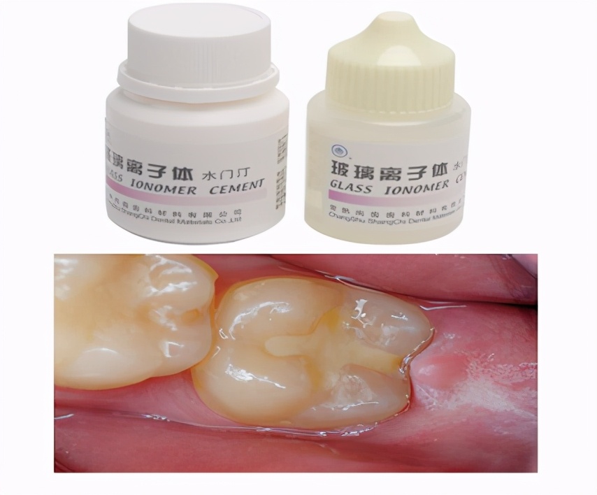 600块钱一颗牙怎么样,600块一颗牙贵吗