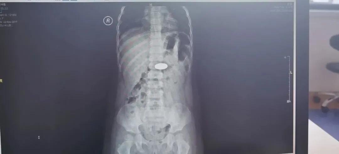 临沂两幼童被严重烧伤最新情况,临沂两个小孩上学被撞