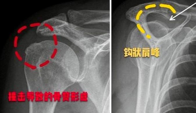 肩周炎甩胳膊越甩越疼,肩周炎甩手臂能自愈吗