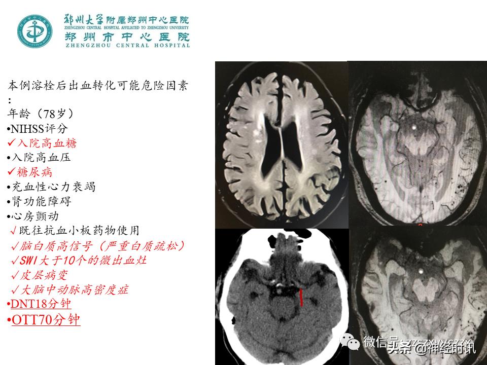 静脉溶栓怎么引起的,静脉相关并发症的预防及处理
