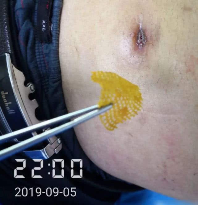 阑尾炎形成窦道的原因,阑尾炎一孔微创手术全过程