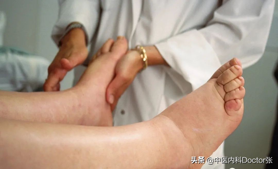 老人脚水肿按压塌陷治疗方法,老人脚水肿一按一个洞