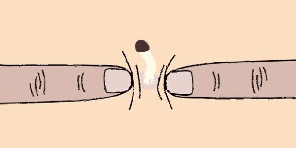 黑头和脂质微丝的区别,黑头里有白色的东西是脂质微丝吗