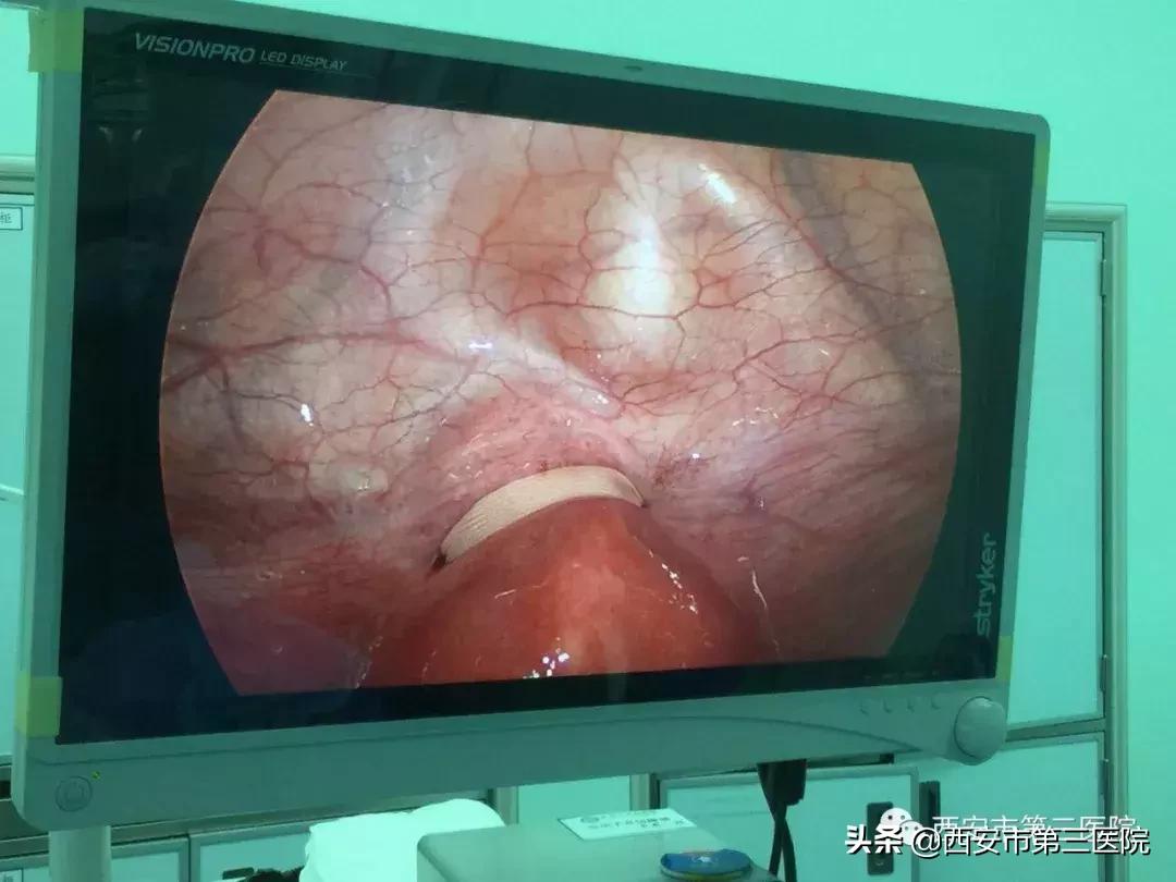 先兆流产宫颈环扎术后保胎率高吗,宫颈环扎术后先兆流产