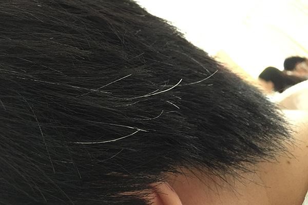 少白头是血热的原因吗,小孩少白头是什么原因