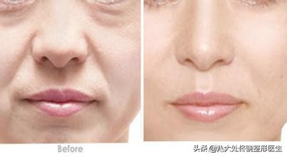 眼窝填充自体脂肪和玻尿酸哪个好,鼻唇沟凹陷物理改善方法