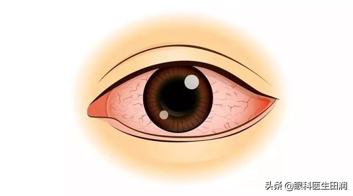 红眼病看一眼就会传染吗,看一眼就传染的病