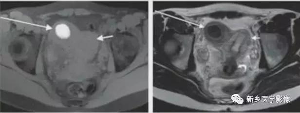 常见的几种子宫畸形诊断标准,先天性子宫畸形是什么原因造成的
