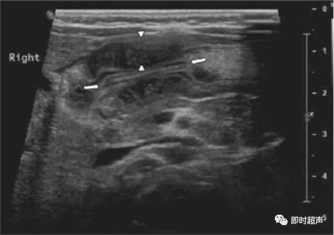 小儿消化道急症超声
