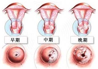 hpv疫苗是预防什么病的,4价hpv预防哪几种病毒