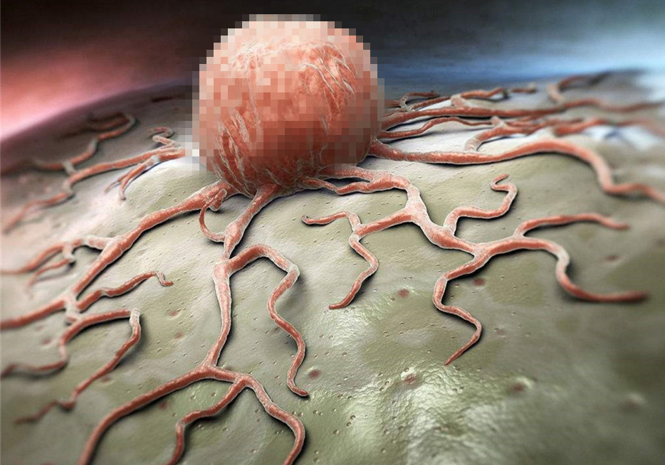 狗脂肪瘤会长大吗,肝上有个脂肪瘤与脂肪肝有关联吗