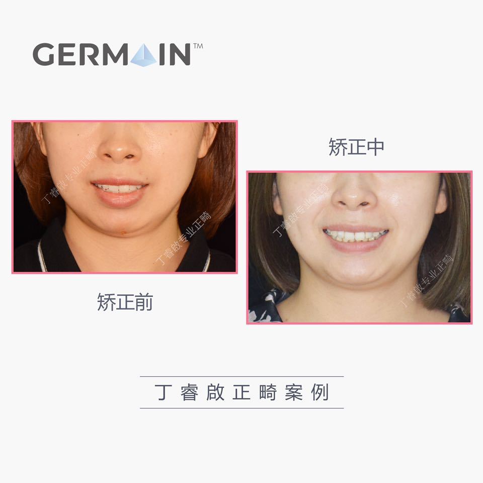 郑州牙齿矫正丁睿啟|下巴后缩病例合集