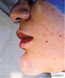 医美注射常识基础知识,医美注射风险