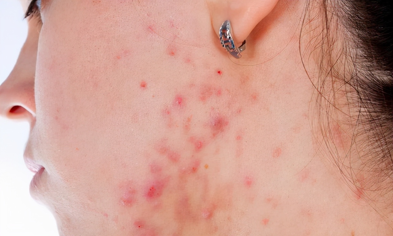 水乳里致敏致痘成分有哪些,致痘的化妆品含量是什么