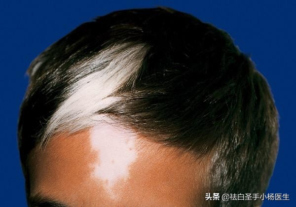 身上长白斑是白癜风吗如何确诊,小孩身上有白斑是白癜风还是汗斑