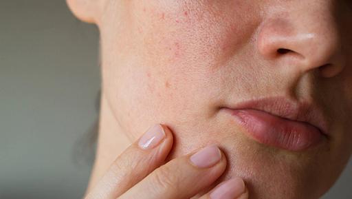 收毛孔有效的果酸产品,可以收缩毛孔的低浓度果酸