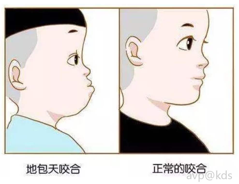 骨性龅牙不处理会越来越严重吗,地包天和龅牙同时存在怎么矫正