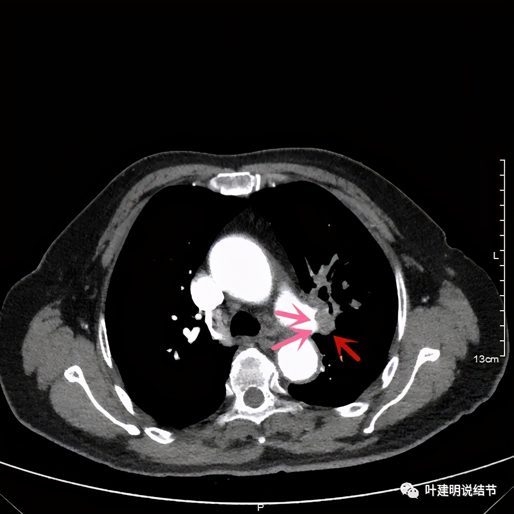 卡瑞利珠单抗治疗肺鳞癌有用吗,特瑞普利单抗对鳞癌治疗有效吗