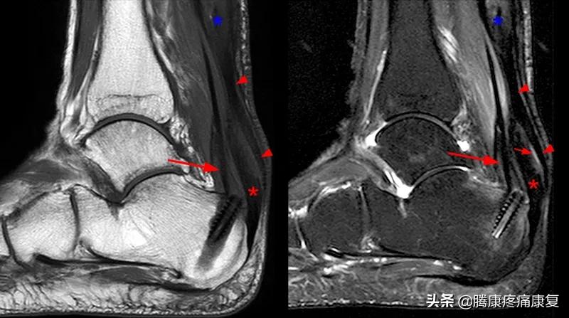 跟腱炎针灸治疗有用吗,足底跟腱炎症状及治疗