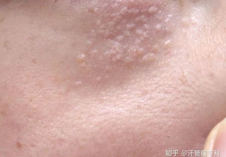 拯救你的卡路里电影,眼部脂肪粒怎么拯救