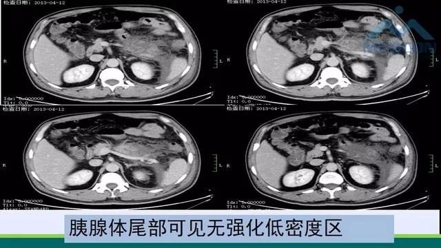 急性胰腺炎的护理措施,急性胰腺炎影像与临床