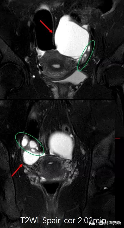 [飞利浦磁共振技术]磁共振扫描下的“女性输卵管成像”，看视频吧