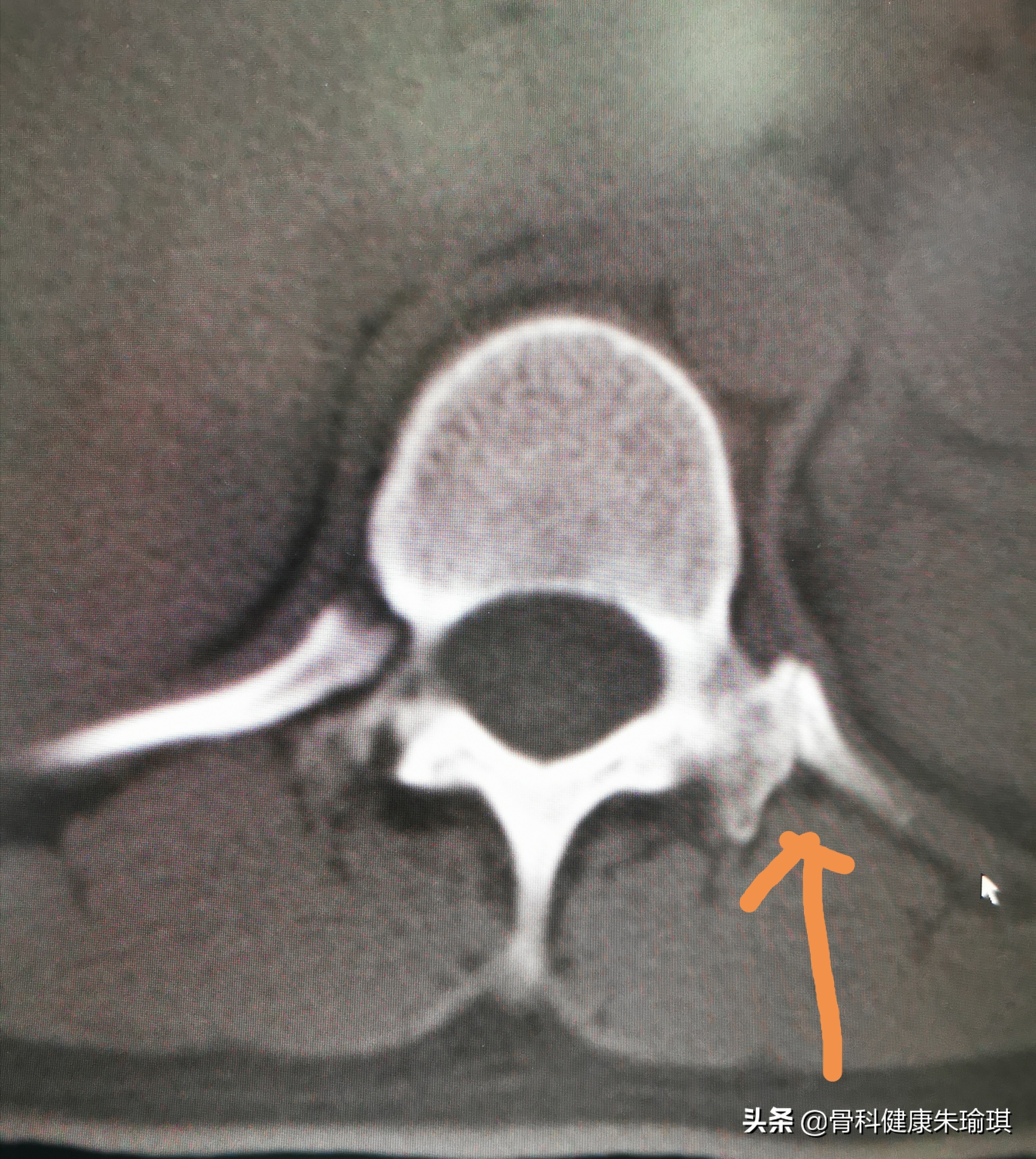 到底是横突骨折？还是正常的肋椎关节？