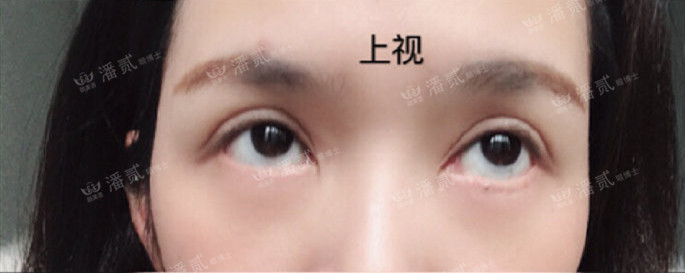 10个工作室做，9个毁，祛眼袋连卧蚕也没了，直接送我到10年后