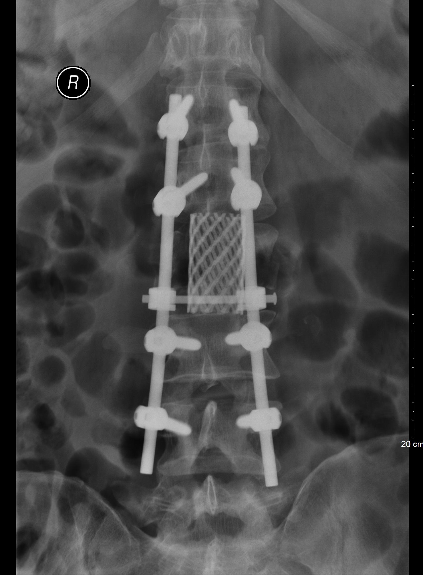 从瘫痪到重新站起来,瘫痪后重新站起来的有吗