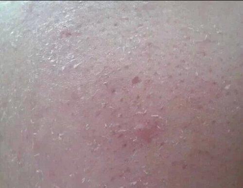 换季皮肤干燥过敏怎么补水保湿,换季皮肤过敏怎么办