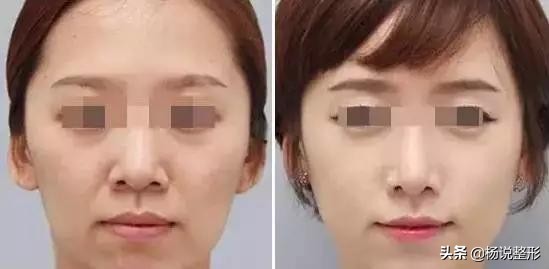 医美都有哪些项目改善皮肤,毛孔粗大的护肤和医美思路有哪些