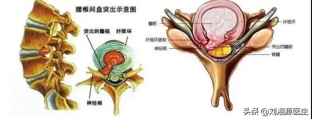 怀孕如何避免强直性脊柱炎,免疫修复治强直性脊柱炎