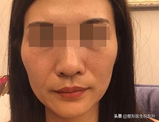 面部五层提升可以维持多久,做完面部提升三件套