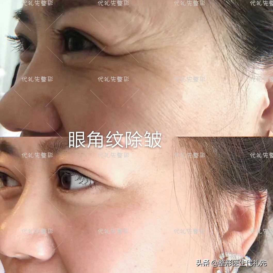 肉毒素最全讲解,肉毒素的十问