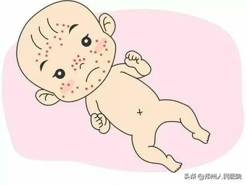 孩子身上长了水猴子怎么治,小孩身上总是长水瘊子