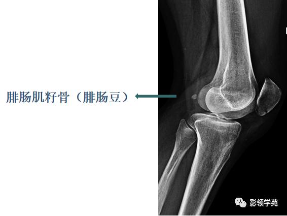 桡骨远端骨折引起尺骨变异,撕脱骨折一个月无明显骨痂形成