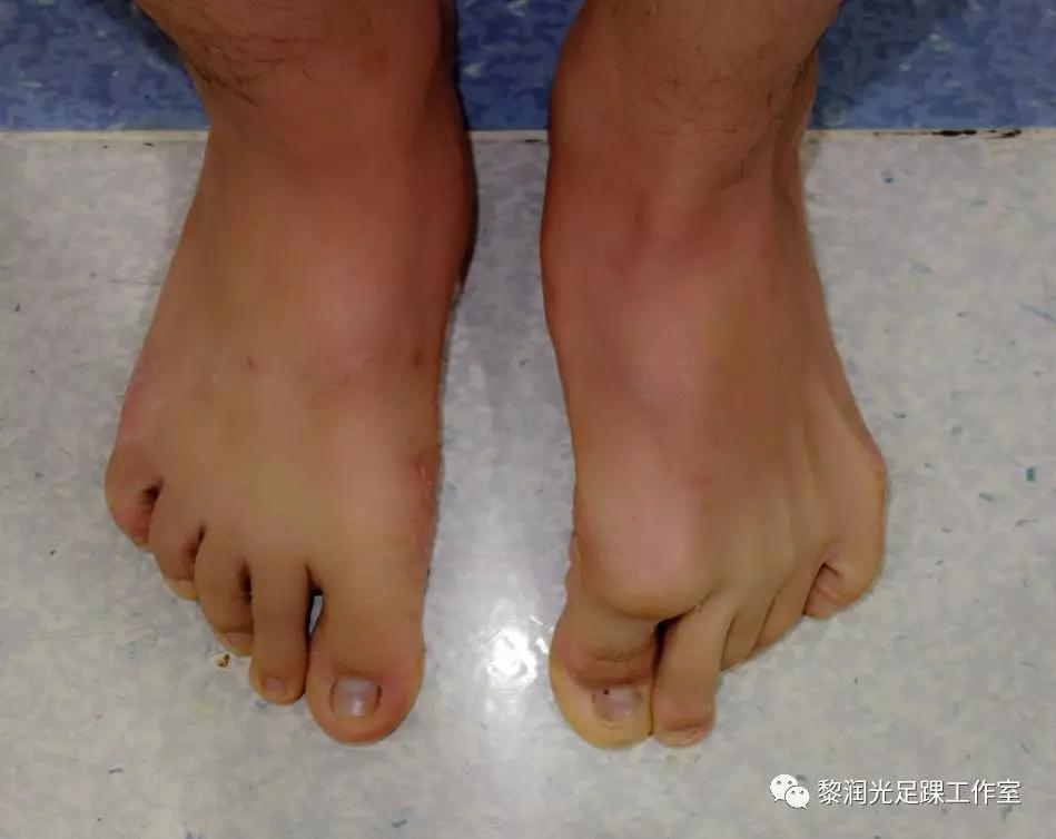 伊里扎洛夫外固定架治疗足部畸形,足部畸形矫正的技巧