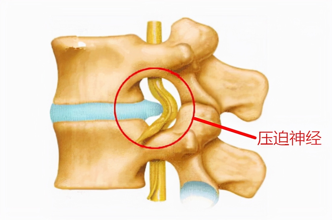 腰椎间盘微创手术后半年康复训练,腰椎间盘突出症微创后康复训练