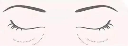 你的黑眼圈是哪种,你的黑眼圈怎么形成的