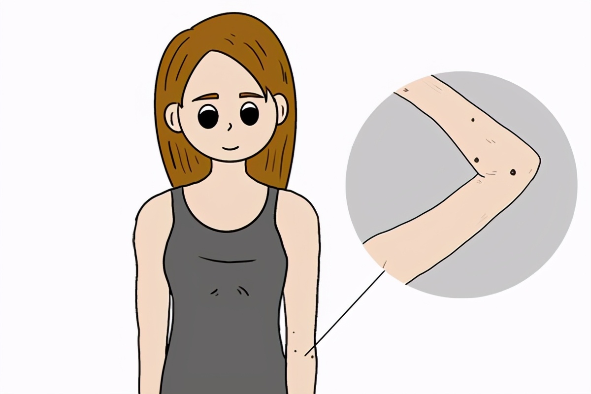 红痣痒越来越多怎么回事,身体长红痣不疼不痒什么原因