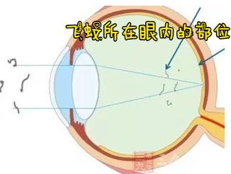 有飞蚊症眼睛睁开一瞬间有黑点,飞蚊症是黑色的圈圈吗